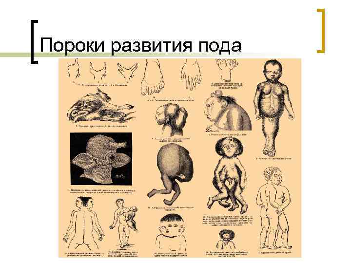 Пороки развития пода 