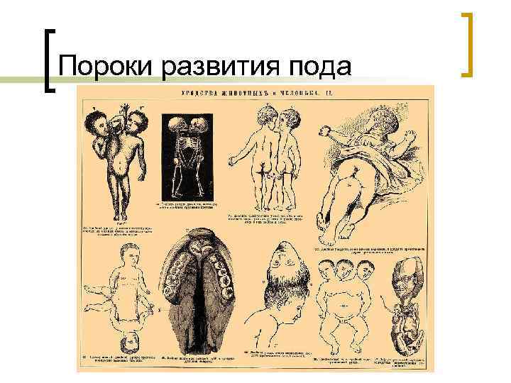 Пороки развития пода 