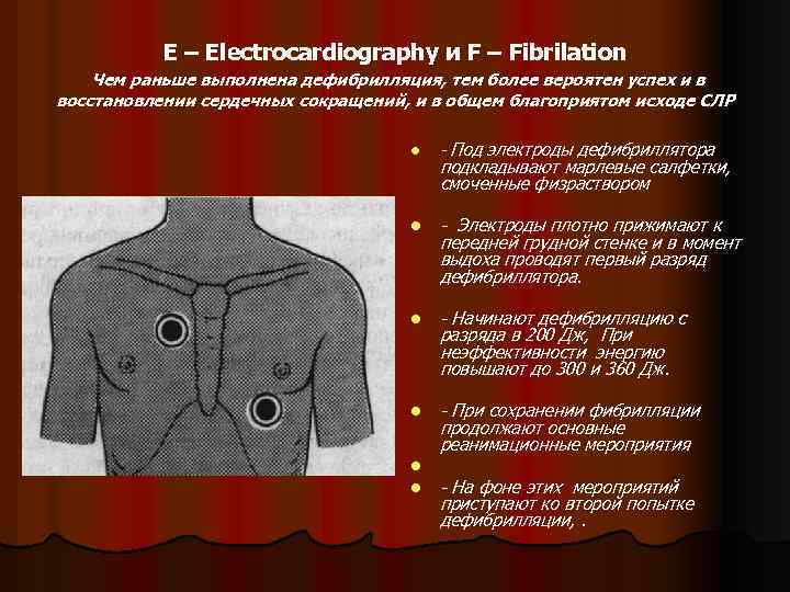 E – Еlectrocardiography и F – Fibrilation Чем раньше выполнена дефибрилляция, тем более вероятен