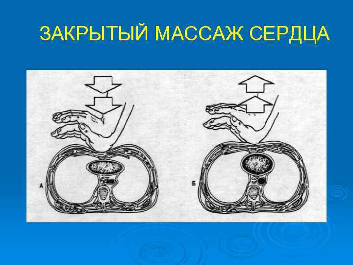 ЗАКРЫТЫЙ МАССАЖ СЕРДЦА 