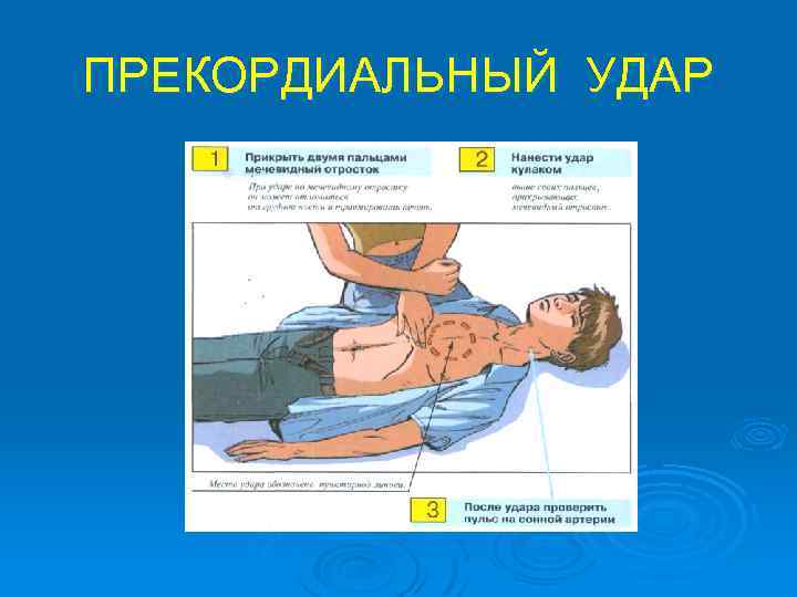 ПРЕКОРДИАЛЬНЫЙ УДАР 