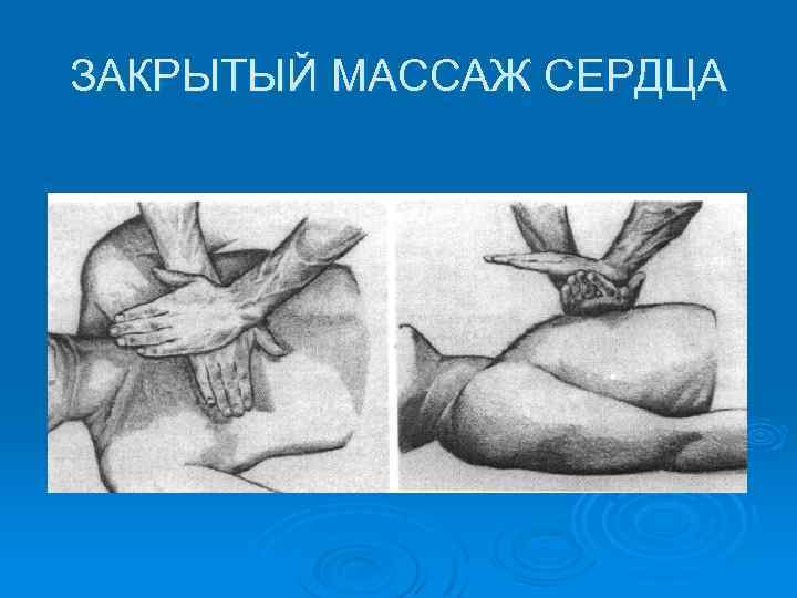 ЗАКРЫТЫЙ МАССАЖ СЕРДЦА 