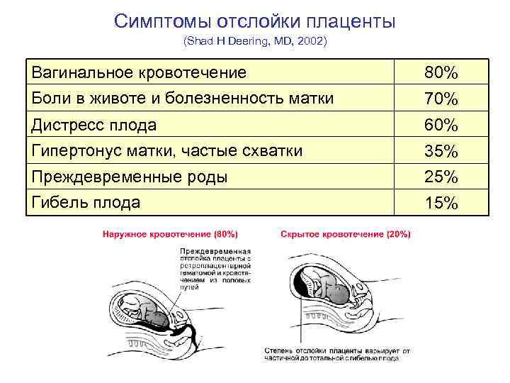 Симптомы отслойки плаценты (Shad H Deering, MD, 2002) Вагинальное кровотечение Боли в животе и