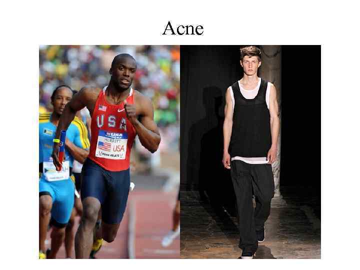 Acne 