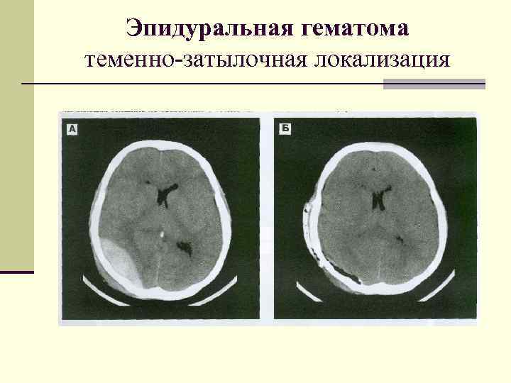 Эпидуральная гематома теменно-затылочная локализация 