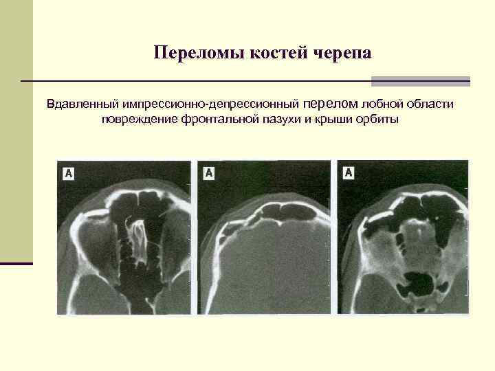 Импрессионный перелом