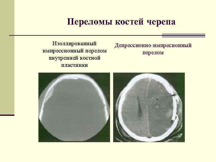 Импрессионный головки кости. Импрессионный перелом кости черепа. Импрессионный перелом черепа рентген. Импрессионный перелом черепа на кт. Вдавленный импрессионный перелом черепа.