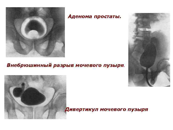 Аденома простаты. Внебрюшинный разрыв мочевого пузыря. Дивертикул мочевого пузыря 