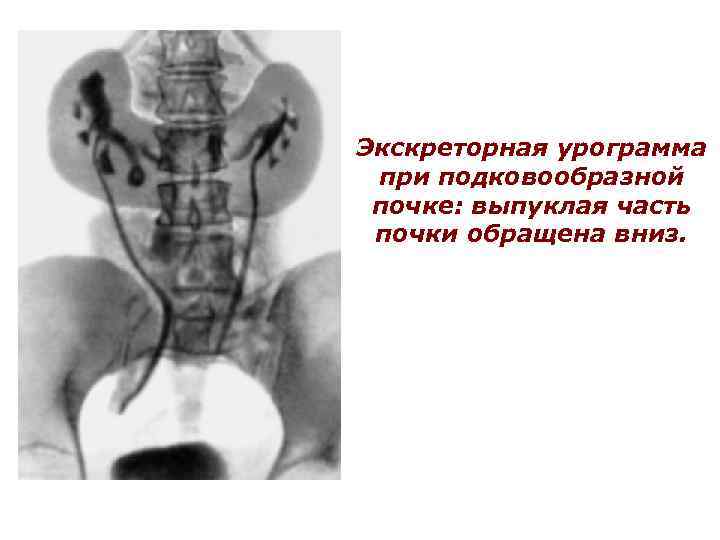 Экскреторная урограмма при подковообразной почке: выпуклая часть почки обращена вниз. 