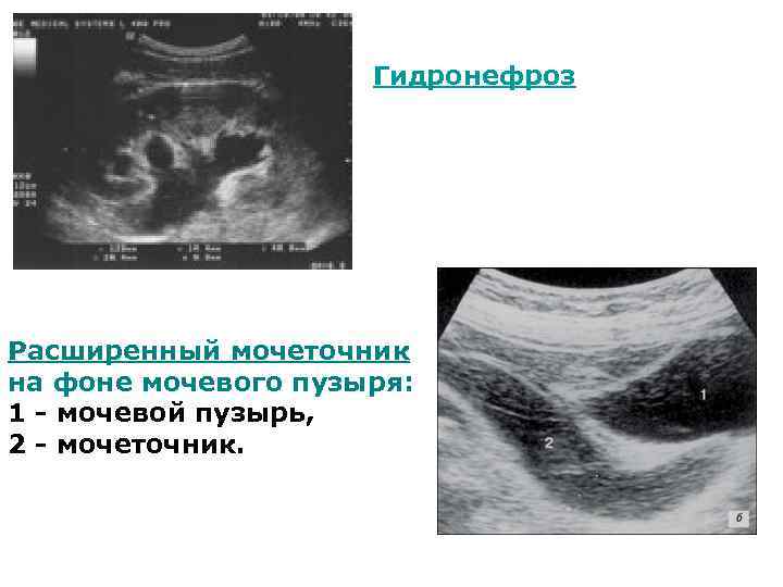 Гидронефроз Расширенный мочеточник на фоне мочевого пузыря: 1 - мочевой пузырь, 2 - мочеточник.