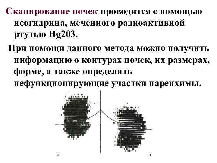 Сканирование почек проводится с помощью неогидрина, меченного радиоактивной ртутью Hg 203. При помощи данного