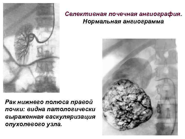 Селективная почечная ангиография. Нормальная ангиограмма Рак нижнего полюса правой почки: видна патологически выраженная васкуляризация