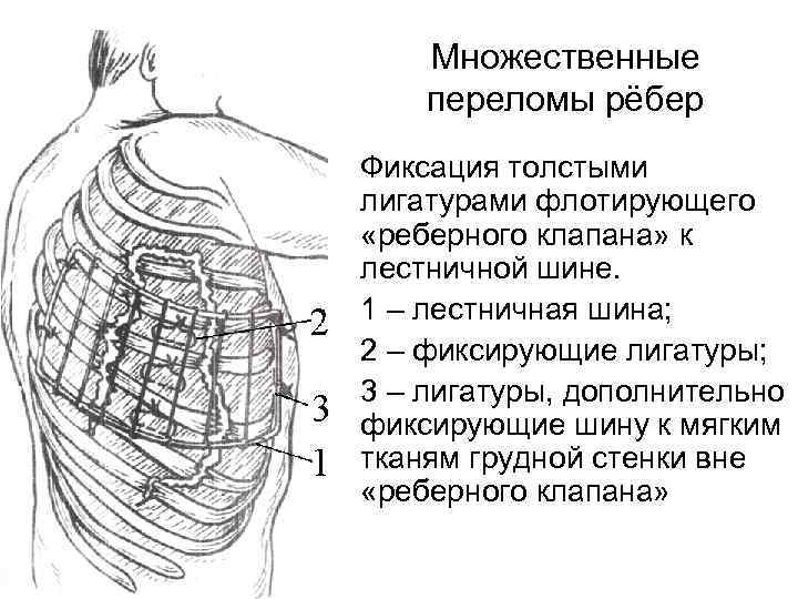 Карта смп перелом ребер