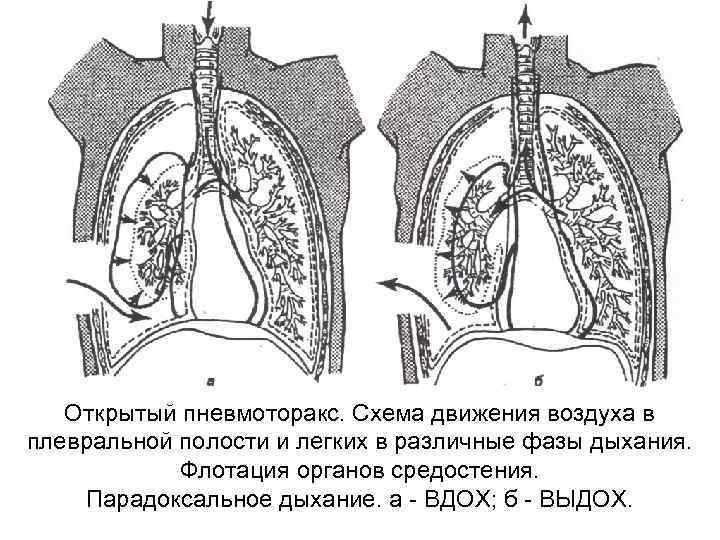 Что такое пневмоторакс. Механизм развития открытого пневмоторакса. Рецидивный пневмоторакс. Смещение органов средостения при пневмотораксе. Пристеночный пневмоторакс на кт.