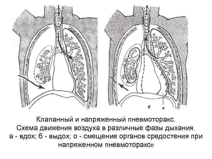 На рентгенологической картине напряженного пиопневмоторакса отмечается смещение средостения в