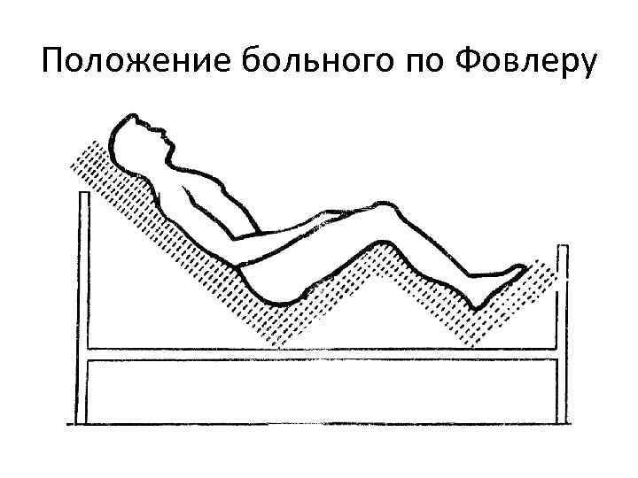 Положение больного по Фовлеру 