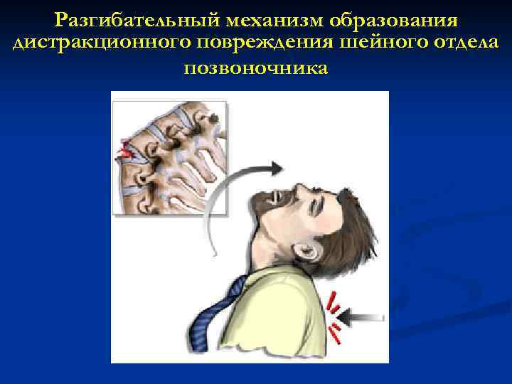 Разгибательный механизм образования дистракционного повреждения шейного отдела позвоночника 
