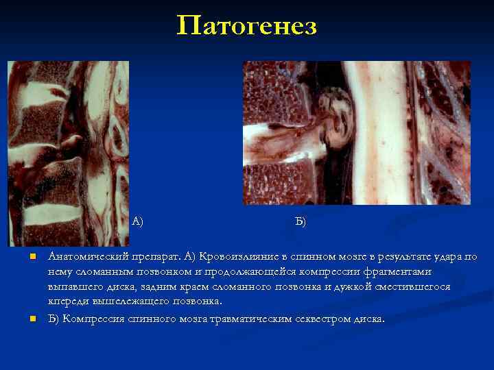 Патогенез А) n n Б) Анатомический препарат. А) Кровоизлияние в спинном мозге в результате