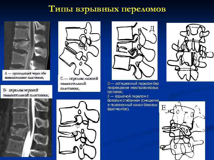 Переломы позвоночника презентация травматология