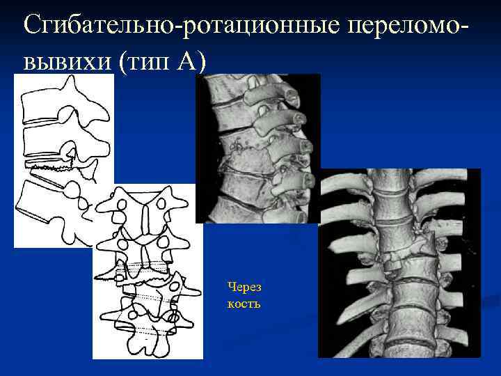 Сгибательно-ротационные переломовывихи (тип А) Через кость 
