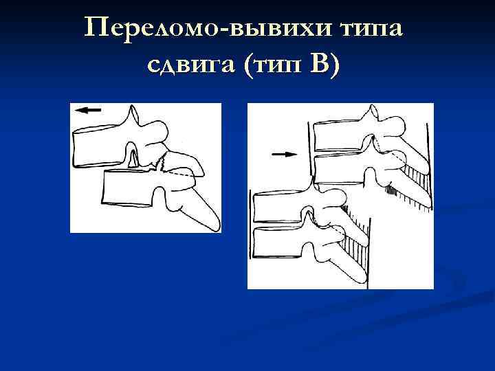 Переломо-вывихи типа сдвига (тип В) 