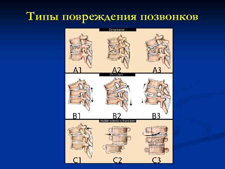 Повреждение позвоночника презентация