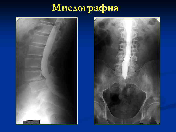 Миелография 