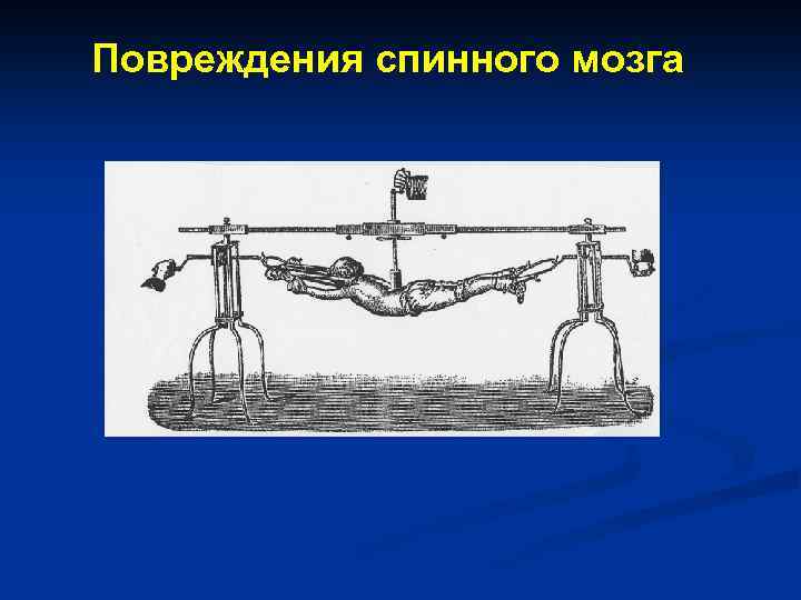 Повреждения спинного мозга 