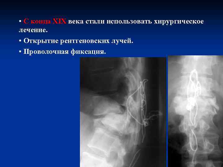  • С конца XIX века стали использовать хирургическое лечение. • Открытие рентгеновских лучей.