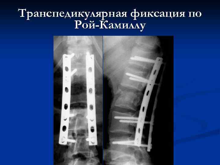 Транспедикулярная фиксация по Рой-Камиллу 