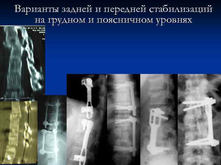 Варианты задней и передней стабилизаций на грудном и поясничном уровнях 