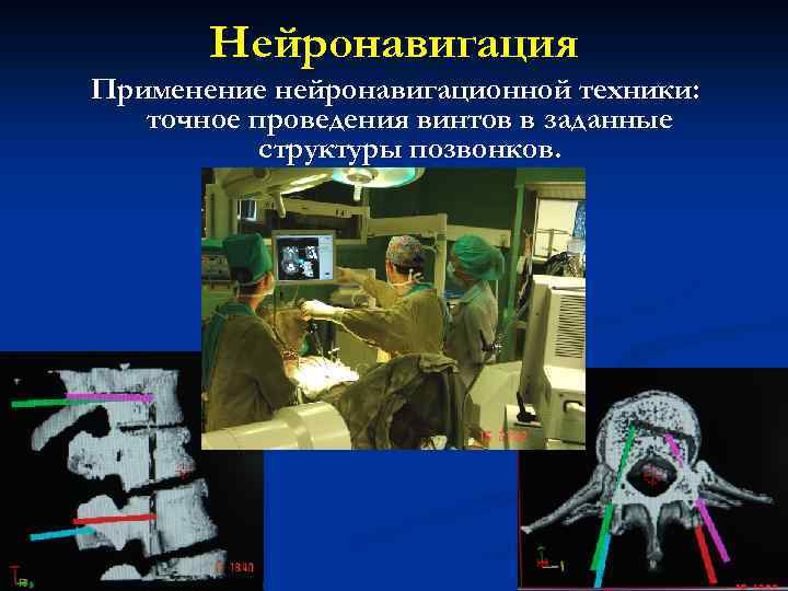 Нейронавигация Применение нейронавигационной техники: точное проведения винтов в заданные структуры позвонков. 