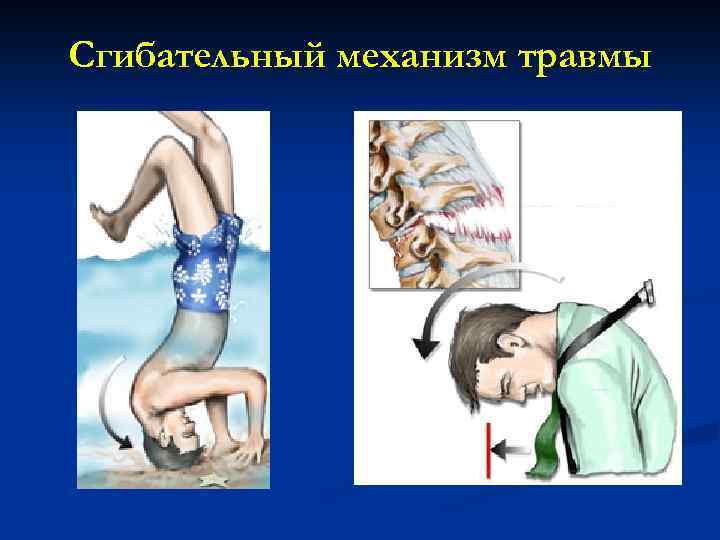 Сгибательный механизм травмы 