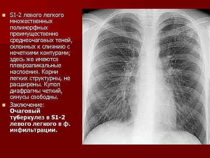 S 1 -2 левого легкого множественных полиморфных преимущественно среднеочаговых теней, склонных к слиянию с