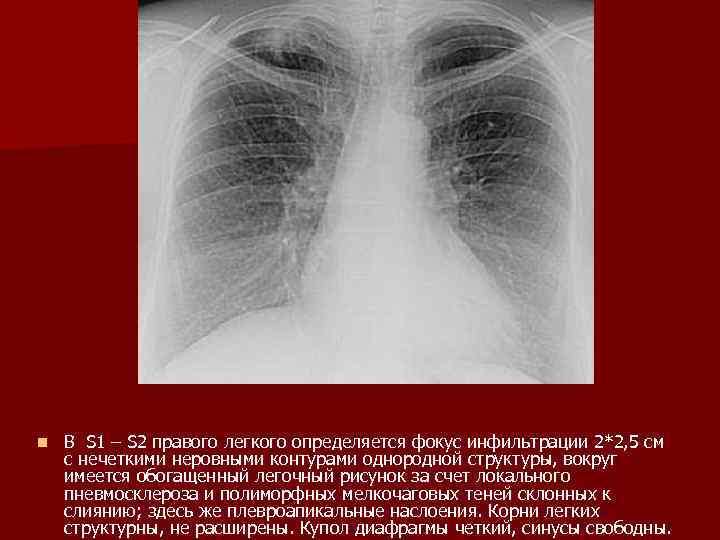 Обогащение легочного рисунка в прикорневой зоне