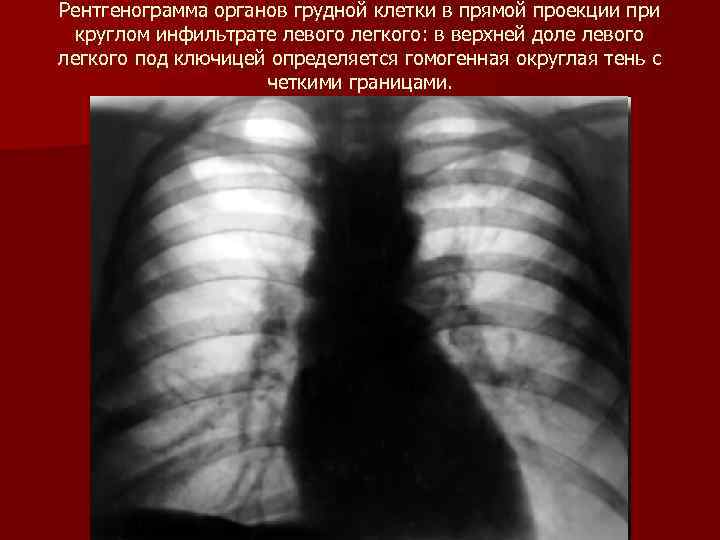 Рентгенограмма органов грудной клетки в прямой проекции при круглом инфильтрате левого легкого: в верхней