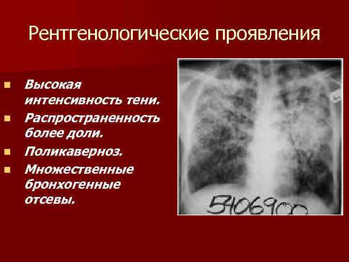 Рентгенологические проявления n n Высокая интенсивность тени. Распространенность более доли. Поликаверноз. Множественные бронхогенные отсевы.