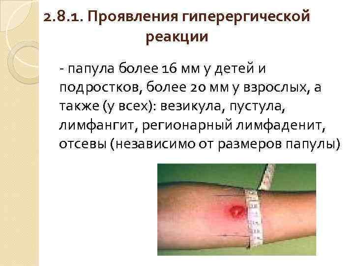 2. 8. 1. Проявления гиперергической реакции - папула более 16 мм у детей и