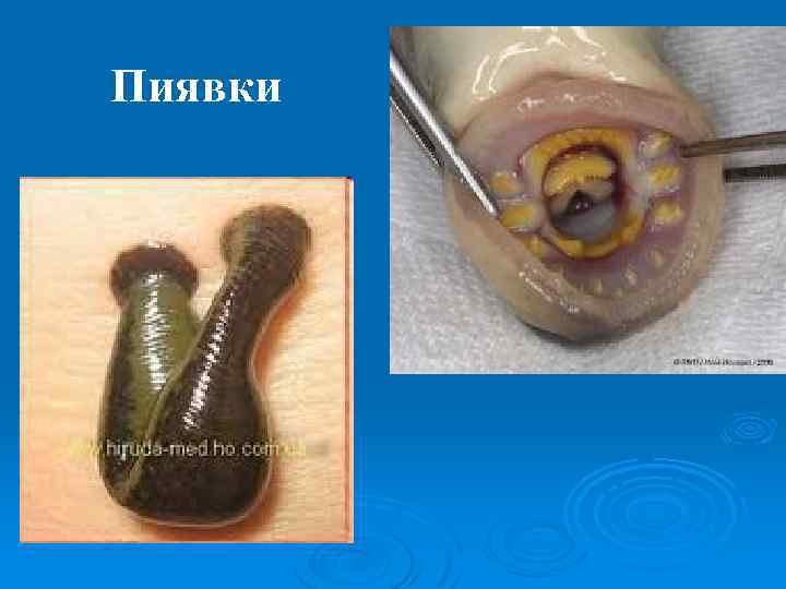 Пиявки 