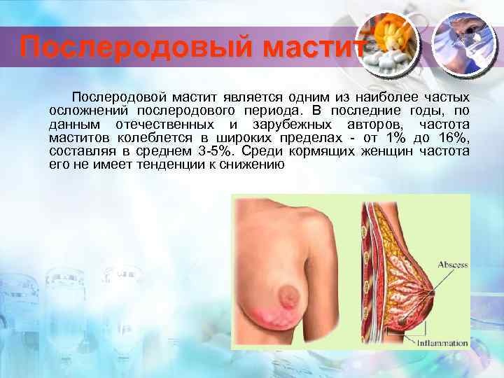 Послеродовый мастит Послеродовой мастит является одним из наиболее частых осложнений послеродового периода. В последние