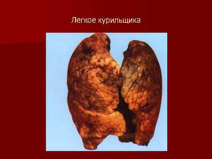 Легкое курильщика 