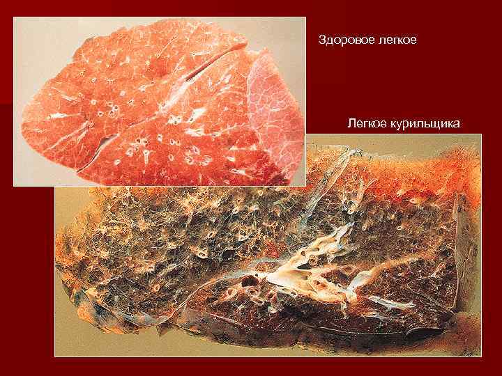 Здоровое легкое Легкое курильщика 