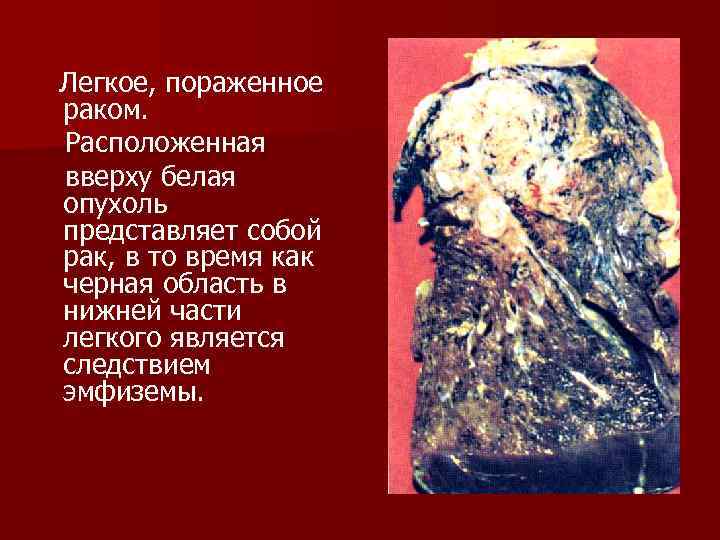  Легкое, пораженное раком. Расположенная вверху белая опухоль представляет собой рак, в то время