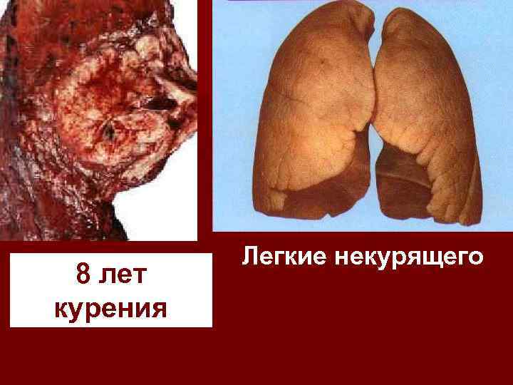 8 лет курения Легкие некурящего 