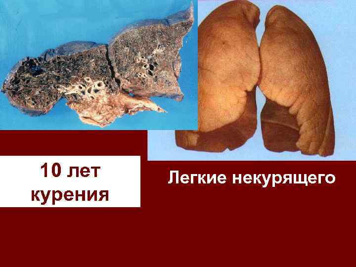 10 лет курения Легкие некурящего 