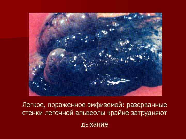 Легкое, пораженное эмфиземой: разорванные стенки легочной альвеолы крайне затрудняют дыхание 
