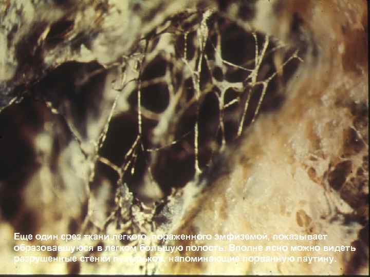 Еще один срез ткани легкого, пораженного эмфиземой, показывает образовавшуюся в легком большую полость. Вполне