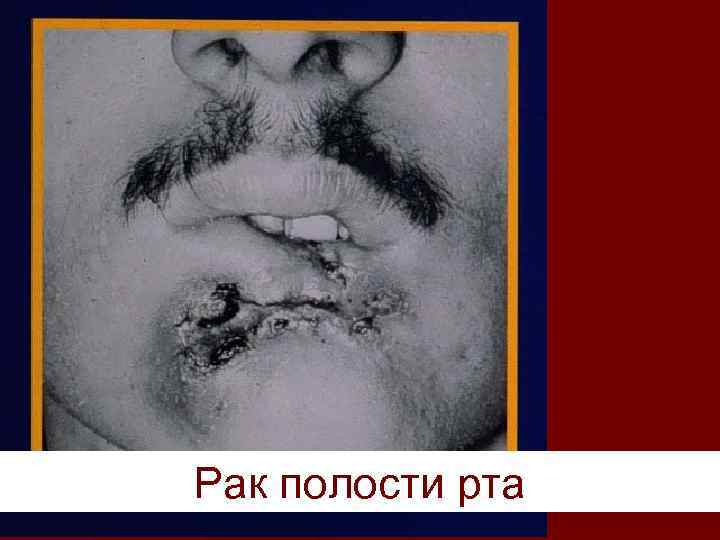 Рак полости рта 