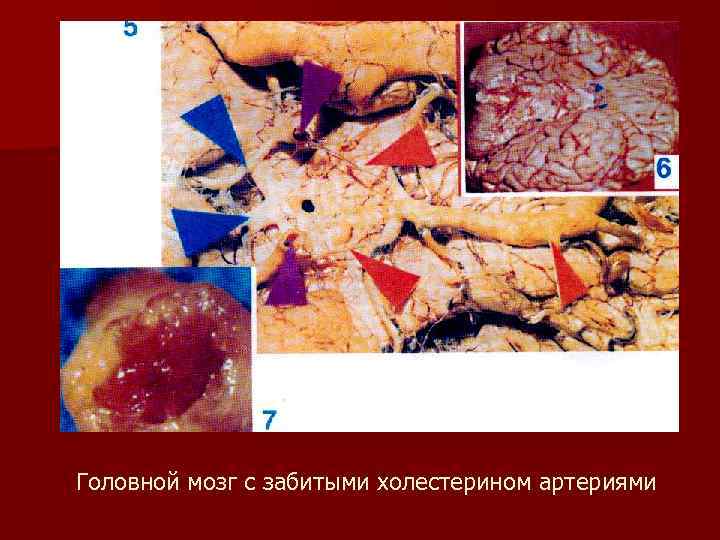  Головной мозг с забитыми холестерином артериями 