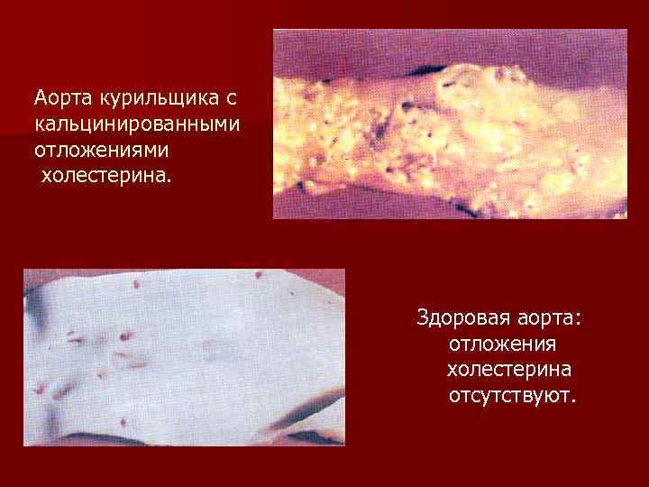 Аорта курильщика с кальцинированными отложениями холестерина. Здоровая аорта: отложения холестерина отсутствуют. 